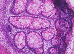 This microscopic image shows a cross section from a teratoma, generated in the lab by authors of a June 9 study in Stem Cell Reports that tested the quality of induced pluripotent stem cells (iPSCs). Teratomas, benign tumors containing the developing cells of different body parts, allowed researchers to see if the iPSCs could form the body’s three basic germ cell lines -  endoderm (gut region), ectoderm (epidermis, nerve tissue, etc.) and mesoderm (muscles, blood cells, etc.). This teratoma in this image includes an area with endoderm tissue.